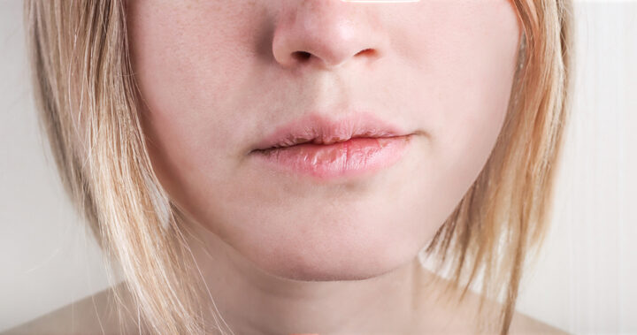 Best Lip Balm for Soothing Windburn and Severely Chapped Lips