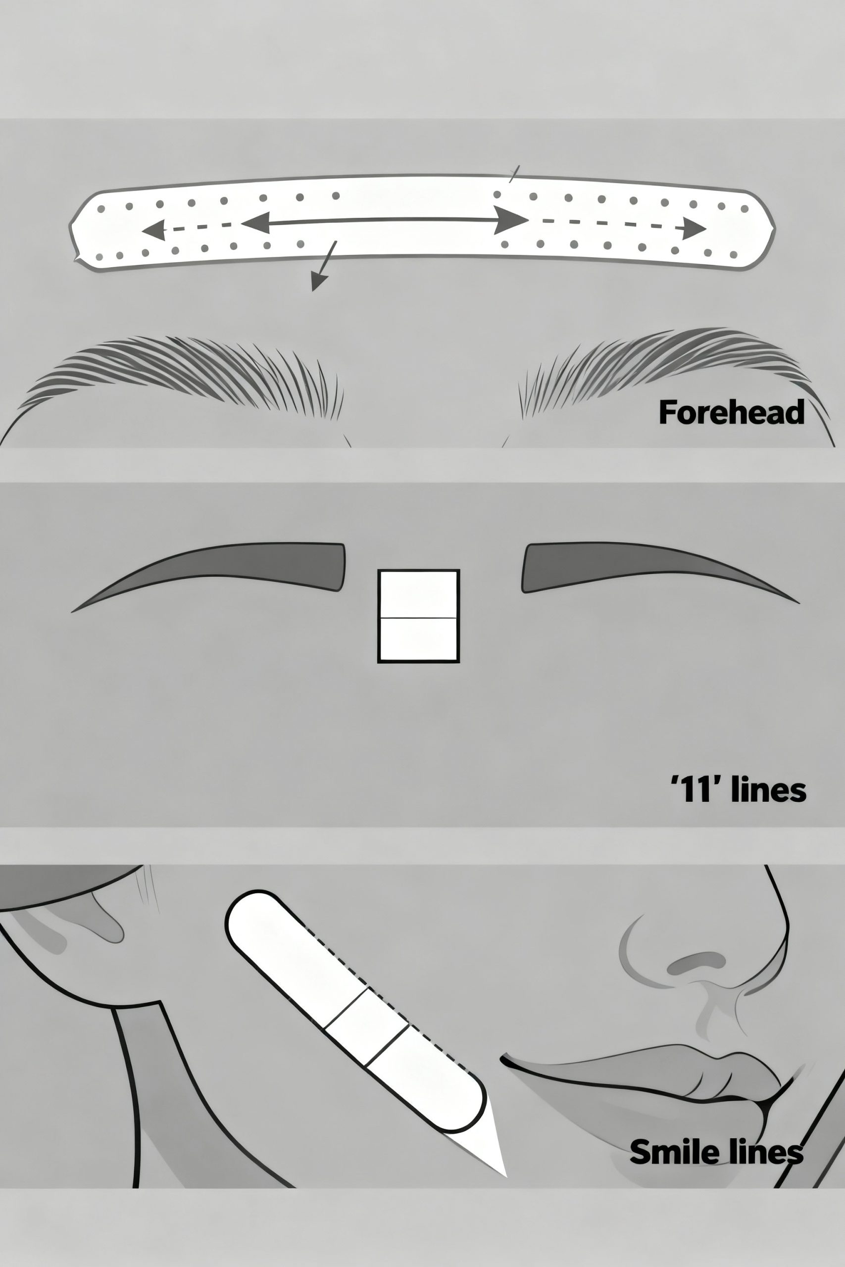 A black and white infographic diagram showing the three correct ways to apply cosmetic tape for facial lines: a horizontal strip for the forehead, a small square for the '11' lines between the brows, and a diagonal strip for smile lines.